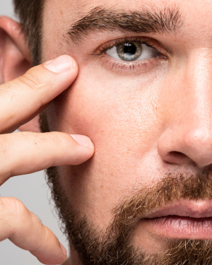 Tratamiento de ojeras